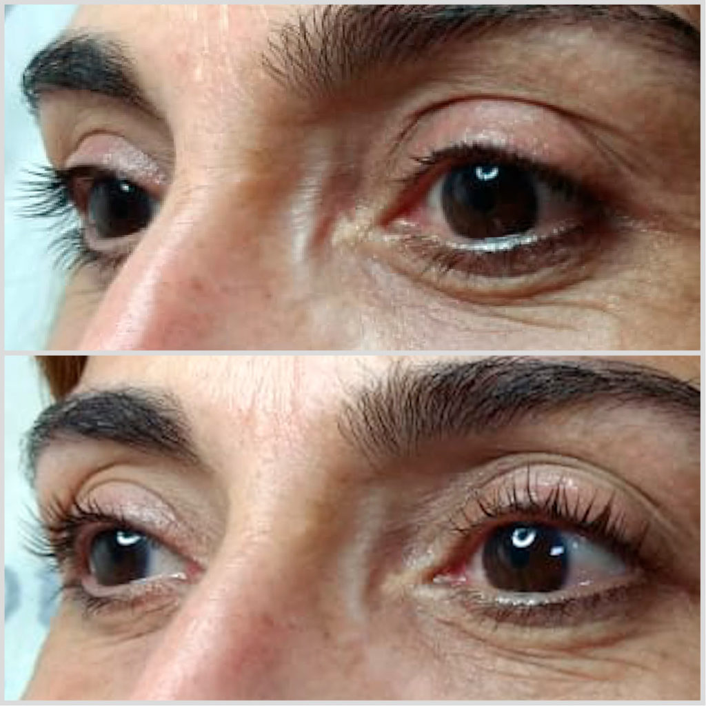 Lifting de Pestañas – Kalós Medicina Estética & Ortomolecula